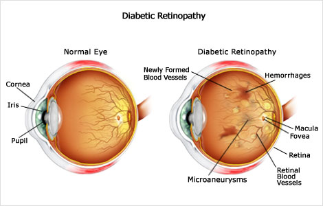 Diabetic Eye Screening